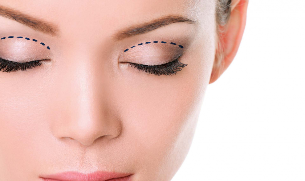 Upper eyelid plastic surgery