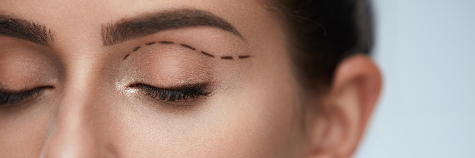 Blepharoplasty